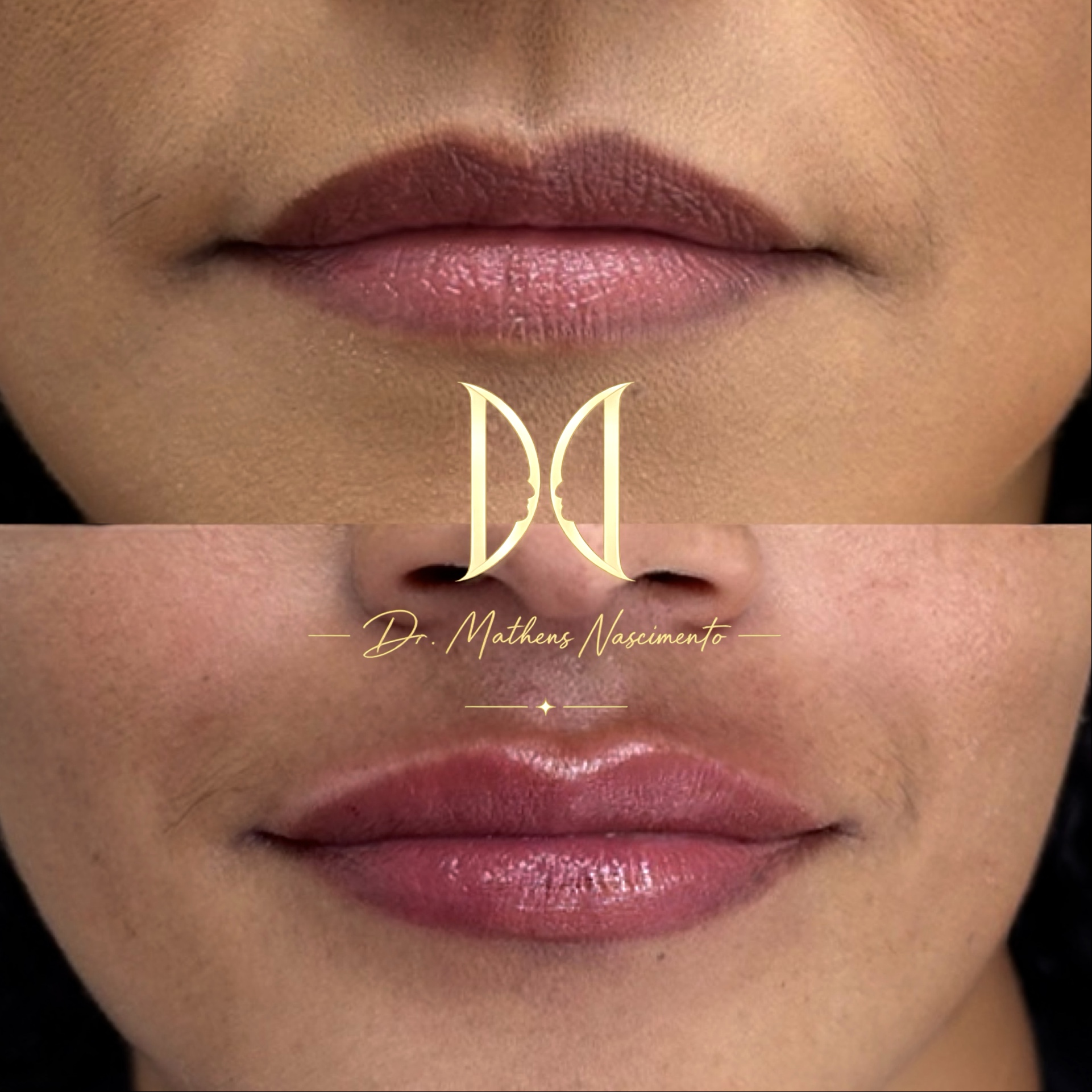 Natural Lips - Resultado Transformador