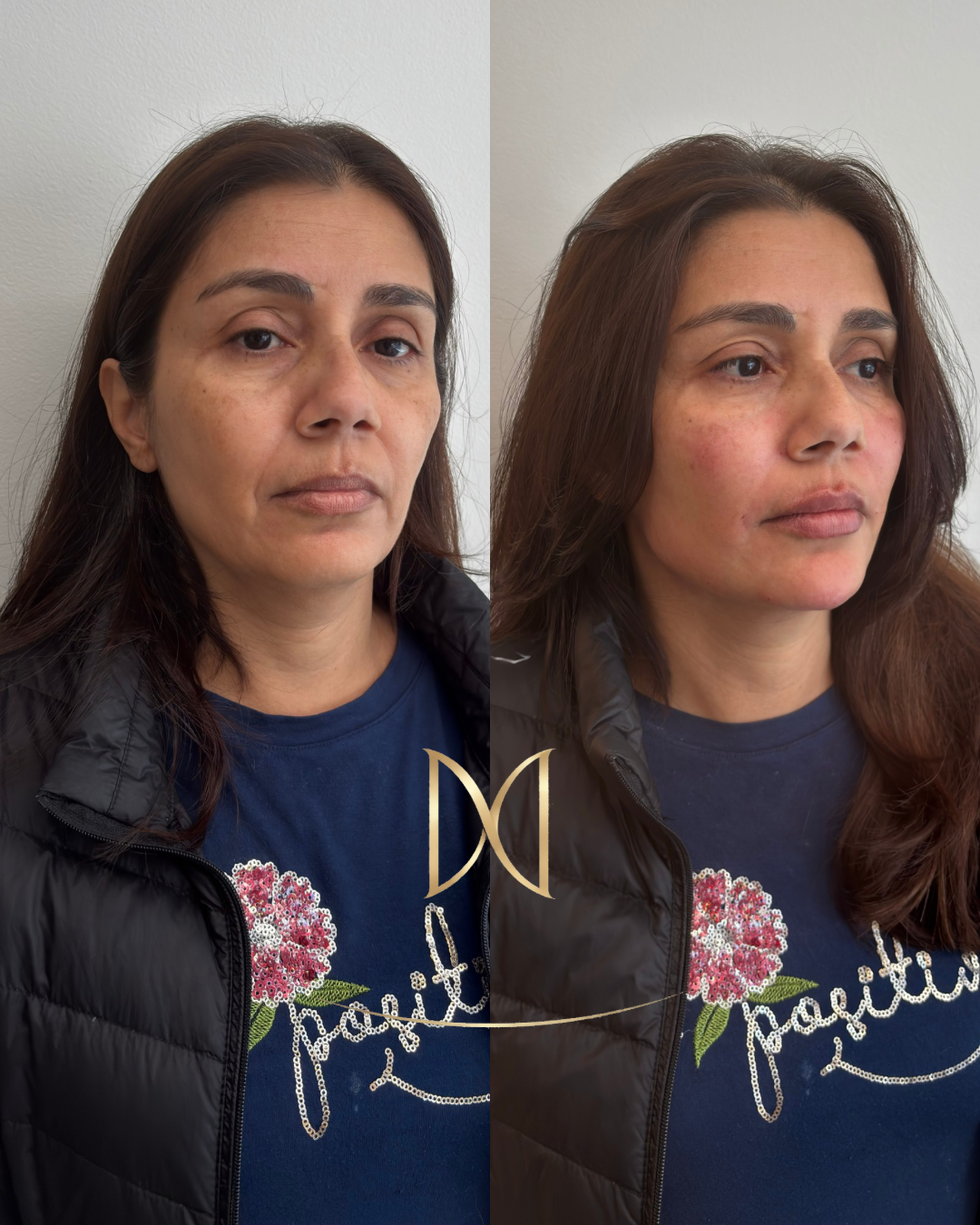 Super Botox Full Face - Rejuvenescimento